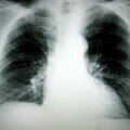 Choosing a Mesothelioma Lawyer