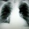 Choosing a Mesothelioma Lawyer